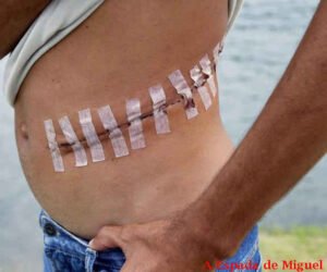 Israel líder mundial no Tráfico de órgãos e seres humanos com apoio dos EUA e Turquia 4 cicatriz-roubo-orgaos-ilegais